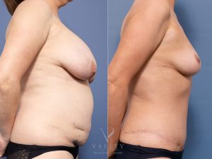 3 - Abdominoplasty Gallery 3