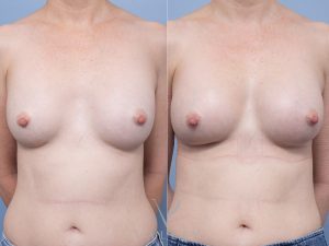 Bilateral breast implant removal and replacement Dr Matthew Cheng