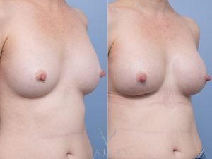 Bilateral breast implant removal and replacement Dr Matthew Cheng