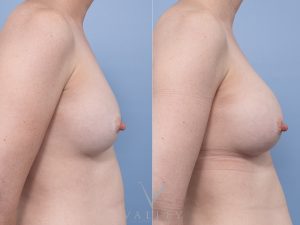 Bilateral breast implant removal and replacement Dr Matthew Cheng