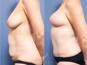 Bilateral Breast Reduction and Abdominoplasty Dr Raymond Goh