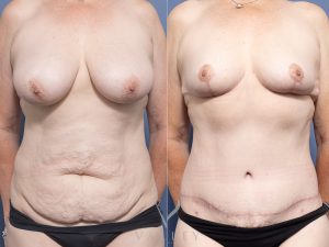 Bilateral Breast Reduction and Circumferential Lipectomy Dr Raymond Goh