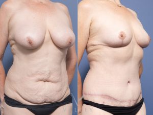 Bilateral Breast Reduction and Circumferential Lipectomy Dr Raymond Goh