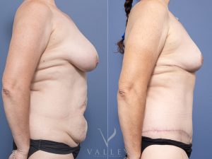 Bilateral Breast Reduction and Circumferential Lipectomy Dr Raymond Goh