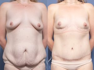 Bilateral Breast Reduction and Circumferential Lipectomy Dr Raymond Goh