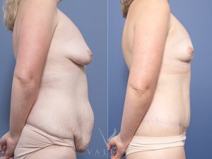 Bilateral Breast Reduction and Circumferential Lipectomy Dr Raymond Goh