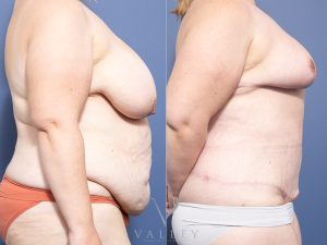 Bilateral Breast Reduction and Belt Lipectomy Dr Raymond Goh