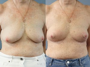 Bilateral Breast Reduction Dr Chris Jardim