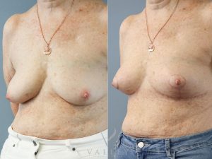 Bilateral Breast Reduction Dr Chris Jardim