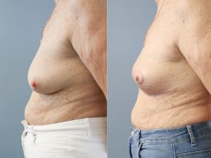 Bilateral Breast Reduction Dr Chris Jardim