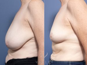Bilateral Breast Reduction Dr Raymond Goh