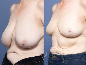 Bilateral Breast Reduction Dr Raymond Goh