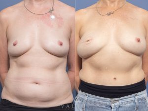 10 ONLY VPS.SPEC website front - Breast Reconstruction Gallery 7