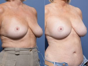 10 oblique - Breast Augmentation Gallery 29