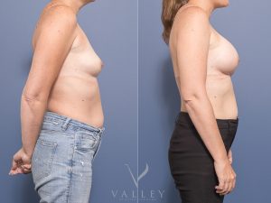 14 BAM 6 weeks side - Breast Augmentation Gallery 24