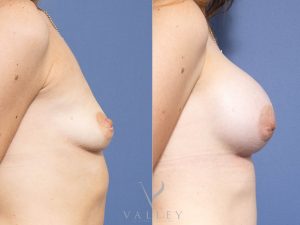 15 side - Breast Augmentation Gallery 27