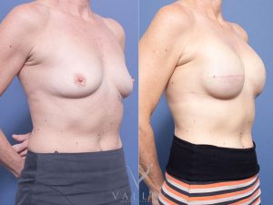 2 Mastectomy TE to implant 5 months angle - Breast Reconstruction Gallery 5