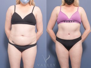 21 abdo 4 months front - Abdominoplasty Gallery 30