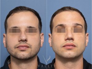 21 front - Rhinoplasty Gallery 62