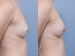 3 Nipple inversion CONSENT TO ALL side - Breast Reconstruction Gallery 24