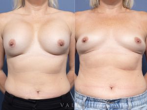 31 front - Breast Augmentation Gallery 34