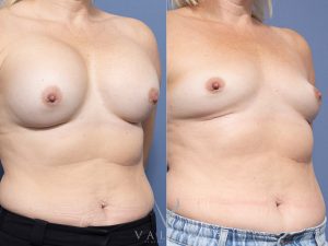 31 ob - Breast Augmentation Gallery 35