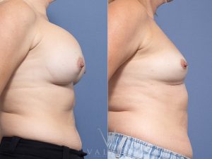 31 side - Breast Augmentation Gallery 36