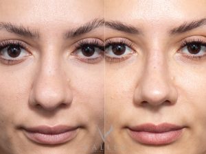 33 front - Rhinoplasty Gallery 74