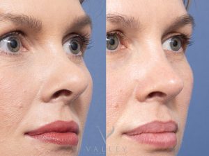 34 ob - Rhinoplasty Gallery 78