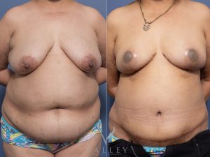 35 front bbr 1 - Belt Lipectomy Gallery 39