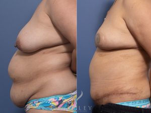 35 side bbr 1 - Belt Lipectomy Gallery 41