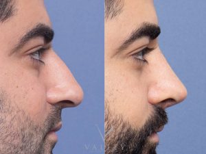 36 side - Rhinoplasty Gallery 82