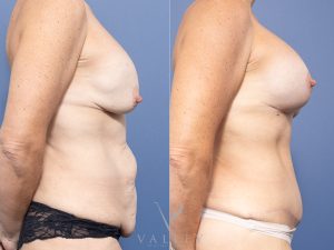 38 side - Breast Augmentation Gallery 39