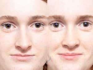 39 front - Rhinoplasty Gallery 88