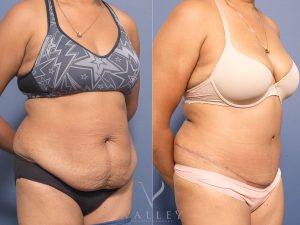 4 abdo 3m angle - Abdominoplasty Gallery 26