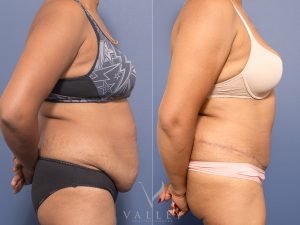 4 abdo 3m side - Abdominoplasty Gallery 27