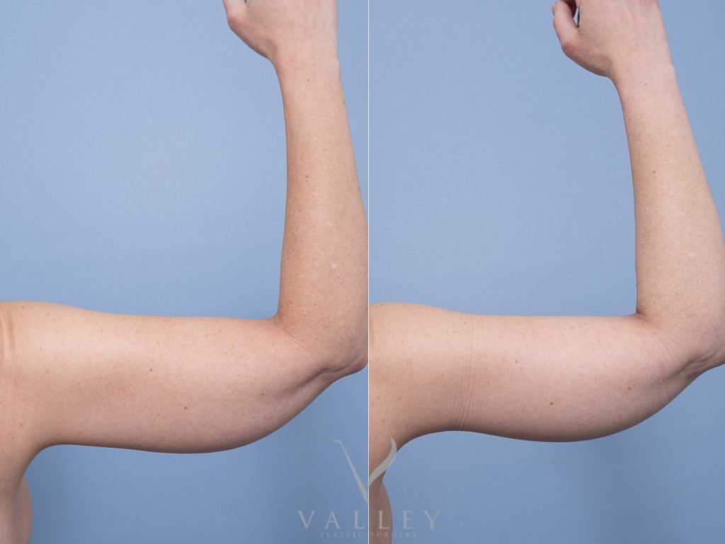 4 back arm - Brachioplasty - Arm Lift Gallery 15