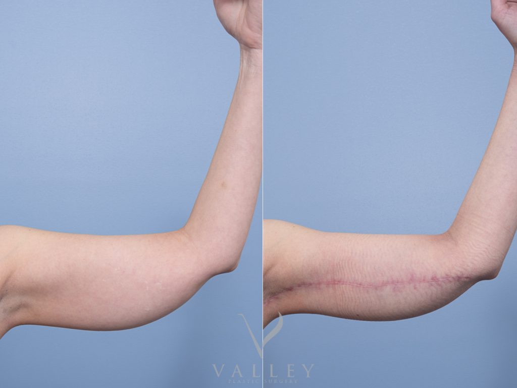 4 front arm - Brachioplasty - Arm Lift Gallery 16