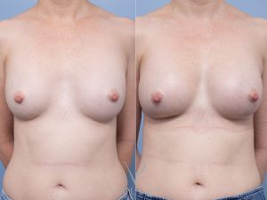 4 front breast - Breast Augmentation Gallery 19