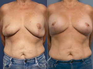 54 front - Breast Augmentation Gallery 43