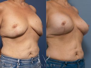 54 ob - Breast Augmentation Gallery 44