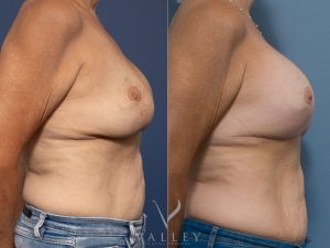 54 side - Breast Augmentation Gallery 45