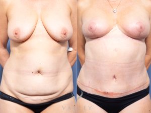 55 abdobbr front 1 - Abdominoplasty Gallery 51