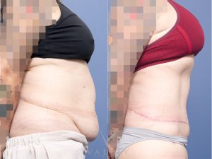 56 side tat - Belt Lipectomy Gallery 62