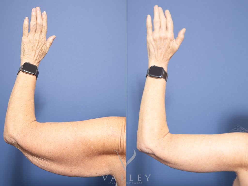 58 back - Brachioplasty - Arm Lift Gallery 14