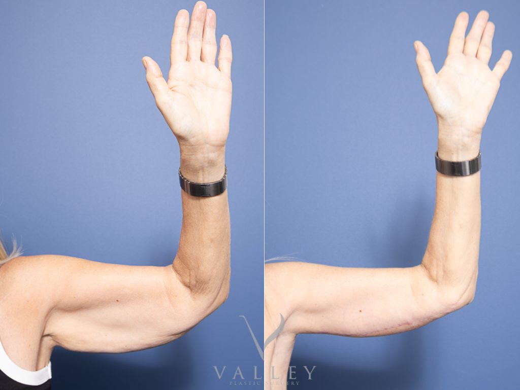 58 front - Brachioplasty - Arm Lift Gallery 13