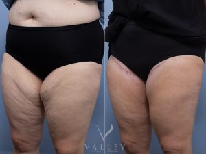 6 ob thigh - Thigh Lift Gallery 5