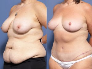 7 ob 3 - Abdominoplasty Gallery 32