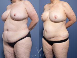 8 brest recon with DIEP and nipple recon 15 months angle - Breast Reconstruction Gallery 11