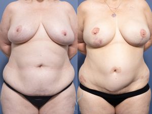 8 brest recon with DIEP and nipple recon 15 months front - Breast Reconstruction Gallery 10